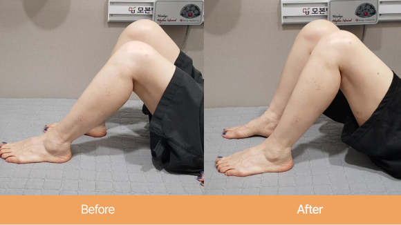 60대 여성 / 퇴행성무릎관절염<br>독비강관절 약침요법(FCID약침 사용) |1회 치료 직후 무릎 가동 범위 회복<br> 2달 집중치료 후 예정된 수술 취소 
